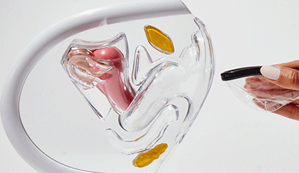 Hand inserting menstrual disc into anatomical pelvic model for demonstration