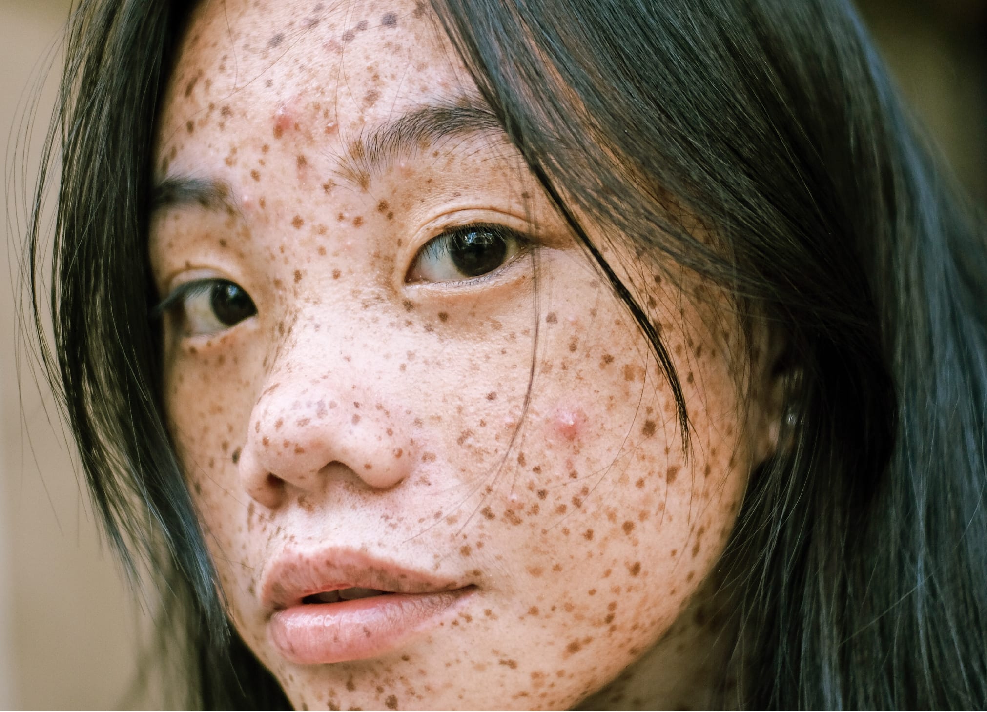 Period acne: What is hormonal acne & what to do about it
