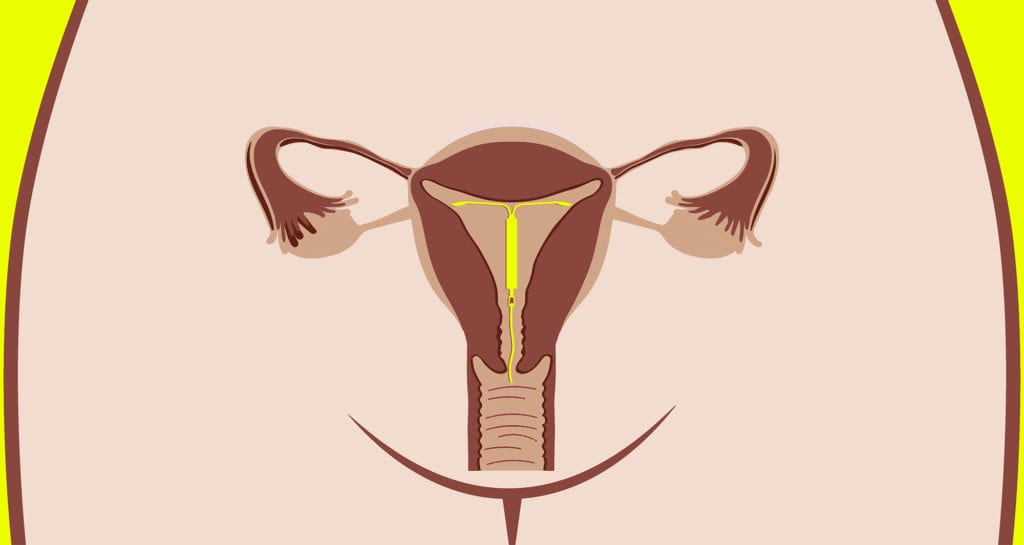 IUD placement in the uterus