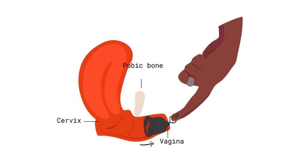 menstrual cup position in the vaginal canal