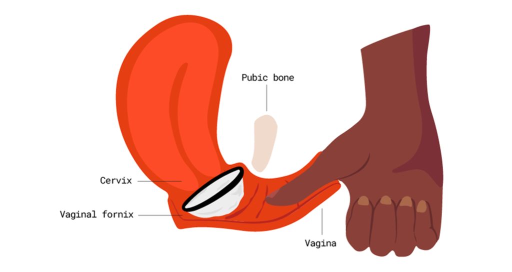 menstrual disc placement in the vaginal fornix