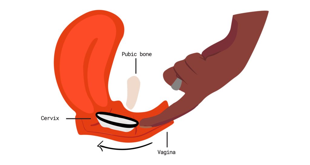 menstrual disc insertion up in the vaginal fornix