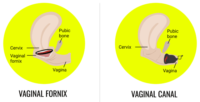 graphic showing menstrual disc position in vaginal fornix and menstrual cup sitting on vaginal canal